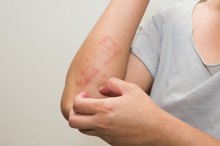 Auf dem Bild sieht man den Arm einer Frau, die ein hellblaues T-Shirt trägt. Sie hat einen rötlichen Ausschlag am Arm und kratzt sich.